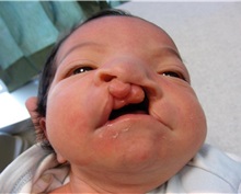 Cleft Lip and Palate Repair Before Photo by Rachel Ruotolo, MD; Garden City, NY - Case 34155