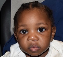 Cleft Lip and Palate Repair After Photo by Rachel Ruotolo, MD; Garden City, NY - Case 35582