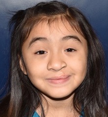 Cleft Lip and Palate Repair After Photo by Rachel Ruotolo, MD; Garden City, NY - Case 37790