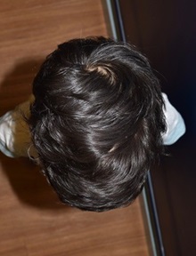 Craniosynostosis After Photo by Rachel Ruotolo, MD; Garden City, NY - Case 38005