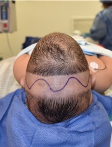Craniosynostosis Before Photo by Rachel Ruotolo, MD; Garden City, NY - Case 38005