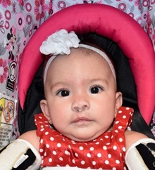 Cleft Lip and Palate Repair After Photo by Rachel Ruotolo, MD; Garden City, NY - Case 44968