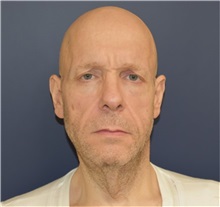 Facelift Before Photo by Richard Reish, MD, FACS; New York, NY - Case 32688
