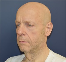 Facelift Before Photo by Richard Reish, MD, FACS; New York, NY - Case 32688