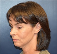Facelift Before Photo by Richard Reish, MD, FACS; New York, NY - Case 32839