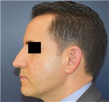 Rhinoplasty Before Photo by Richard Reish, MD, FACS; New York, NY - Case 35331