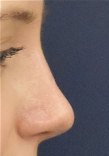 Rhinoplasty After Photo by Richard Reish, MD, FACS; New York, NY - Case 43459