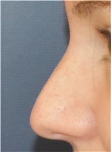 Rhinoplasty Before Photo by Richard Reish, MD, FACS; New York, NY - Case 43527