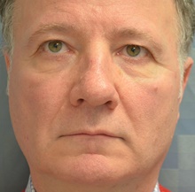 Rhinoplasty After Photo by Mark McRae, MD, FRCS(C); Burlington, ON - Case 38953