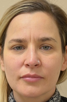 Rhinoplasty Before Photo by Mark McRae, MD, FRCS(C); Burlington, ON - Case 44330