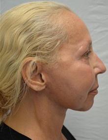 Facelift After Photo by Mark McRae, MD, FRCS(C); Burlington, ON - Case 46594