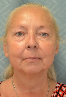 Facelift Before Photo by Mark McRae, MD, FRCS(C); Burlington, ON - Case 46594