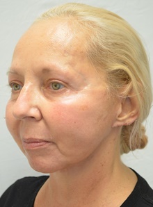 Facelift After Photo by Mark McRae, MD, FRCS(C); Burlington, ON - Case 46594
