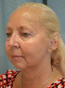 Facelift Before Photo by Mark McRae, MD, FRCS(C); Burlington, ON - Case 46594