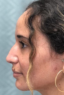 Rhinoplasty Before Photo by Mark McRae, MD, FRCS(C); Burlington, ON - Case 46616