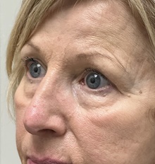 Eyelid Surgery Before Photo by Mark McRae, MD, FRCS(C); Burlington, ON - Case 47867
