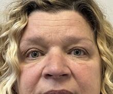 Brow Lift After Photo by Mark McRae, MD, FRCS(C); Burlington, ON - Case 48437