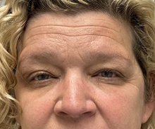 Brow Lift Before Photo by Mark McRae, MD, FRCS(C); Burlington, ON - Case 48437