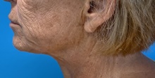 Facelift Before Photo by Eric Wright, MD; Little Rock, AR - Case 48569