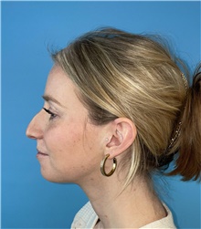 Rhinoplasty Before Photo by Mark Markarian, MD, MSPH, FACS; Wellesley, MA - Case 47915
