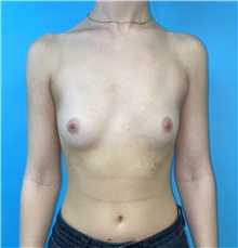 Breast Augmentation Before Photo by Mark Markarian, MD, MSPH, FACS; Wellesley, MA - Case 48521