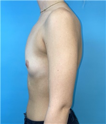 Breast Augmentation Before Photo by Mark Markarian, MD, MSPH, FACS; Wellesley, MA - Case 48521