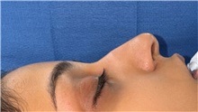 Rhinoplasty Before Photo by Mark Markarian, MD, MSPH, FACS; Wellesley, MA - Case 48781