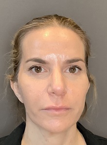 Facelift After Photo by Mark Albert, MD; New York, NY - Case 48509