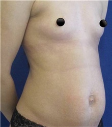Tummy Tuck Before Photo by Munique Maia, MD; Tysons Corner, VA - Case 48938