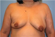 Breast Reconstruction Before Photo by Kristoffer Ning Chang, MD; San Francisco, CA - Case 46006