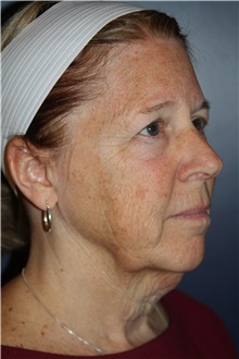 Facelift Before Photo by Larry Weinstein, MD; Chester, NJ - Case 30656
