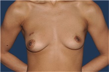 Breast Reconstruction Before Photo by Jerry Weiger Chang, MD, FACS; Flushing, NY - Case 43267