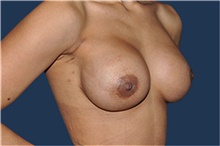 Breast Reconstruction After Photo by Jerry Weiger Chang, MD, FACS; Flushing, NY - Case 43267