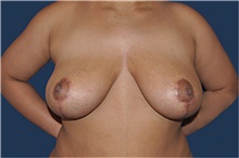 Breast Reduction After Photo by Jerry Weiger Chang, MD, FACS; Flushing, NY - Case 44886