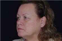 Brow Lift Before Photo by Landon Pryor, MD, FACS; Rockford, IL - Case 38925
