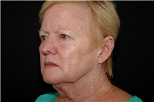 Brow Lift Before Photo by Landon Pryor, MD, FACS; Rockford, IL - Case 38986