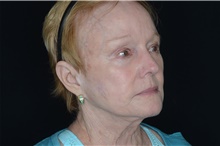 Brow Lift After Photo by Landon Pryor, MD, FACS; Rockford, IL - Case 38986