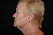 Brow Lift Before Photo by Landon Pryor, MD, FACS; Rockford, IL - Case 38986