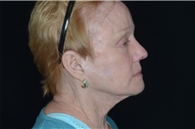 Brow Lift After Photo by Landon Pryor, MD, FACS; Rockford, IL - Case 38986