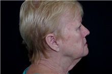 Brow Lift Before Photo by Landon Pryor, MD, FACS; Rockford, IL - Case 38986