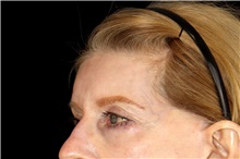 Brow Lift Before Photo by Landon Pryor, MD, FACS; Rockford, IL - Case 45891
