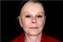 Facelift After Photo by Landon Pryor, MD, FACS; Rockford, IL - Case 47489
