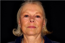 Facelift Before Photo by Landon Pryor, MD, FACS; Rockford, IL - Case 47489