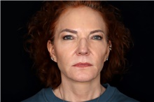 Facelift After Photo by Landon Pryor, MD, FACS; Rockford, IL - Case 47535