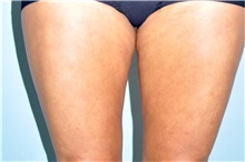 Thigh Lift Before Photo by Keyian Paydar, MD, FACS; Newport Beach, CA - Case 49601