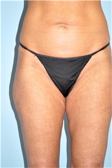 Thigh Lift Before Photo by Keyian Paydar, MD, FACS; Newport Beach, CA - Case 49600