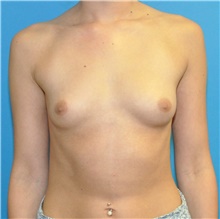 Breast Augmentation Before Photo by Joshua Cooper, MD; Seattle, WA - Case 41620