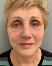 Facelift After Photo by Franklin Richards, MD; Bethesda, MD - Case 46148