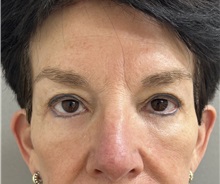 Brow Lift After Photo by Franklin Richards, MD; Bethesda, MD - Case 49697