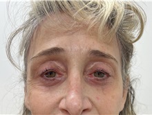 Brow Lift After Photo by Franklin Richards, MD; Bethesda, MD - Case 49716